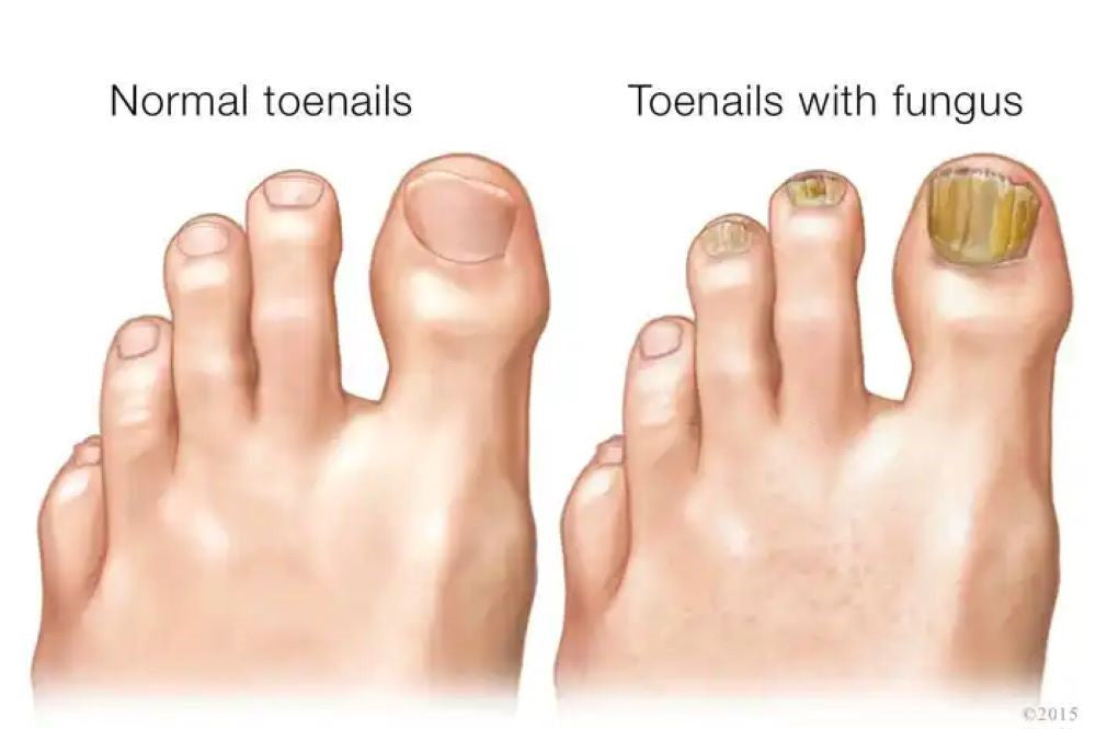 Onychomycosis vs. Other Toenail Infections: How to Tell the Difference