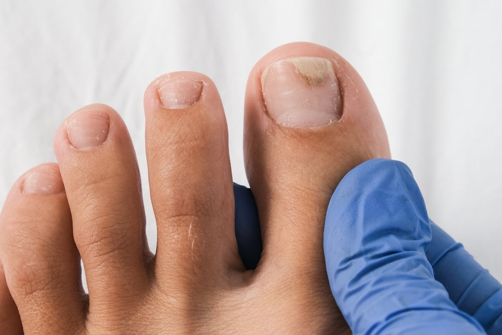 How to Identify Early Signs of Toenail Fungus (Onychomycosis) and Stop It in Its Tracks